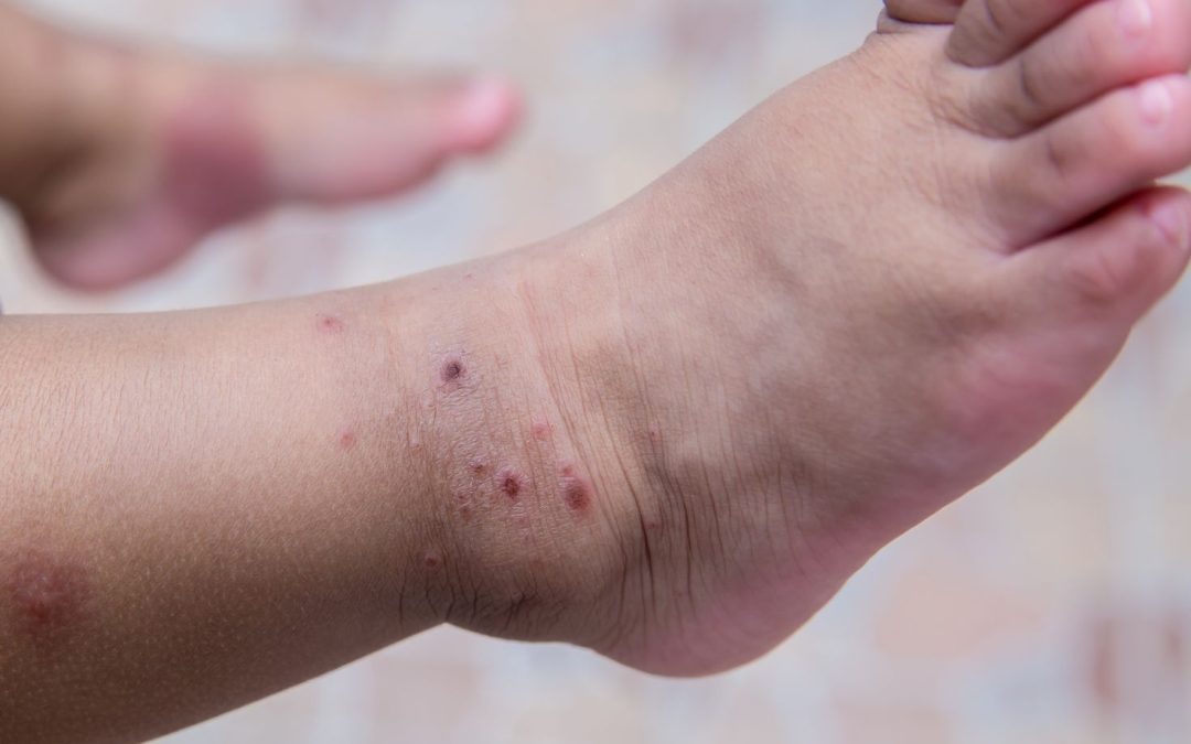 Die Hand-Mund-Fuss-Krankheit bei Kindern